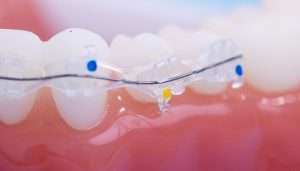 Modelo dental con brackets cerámicos transparentes y alambre metálico sobre dientes blancos y encía rosada, ilustrando ortodoncia estética.