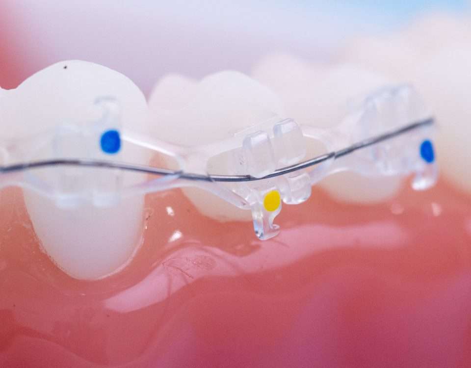 Modelo dental con brackets cerámicos transparentes y alambre metálico sobre dientes blancos y encía rosada, ilustrando ortodoncia estética.