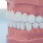 Modelo de maxilar con alineadores transparentes ajustados sobre los dientes para ortodoncia invisible