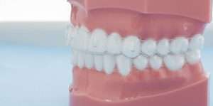 Modelo de maxilar con alineadores transparentes ajustados sobre los dientes para ortodoncia invisible