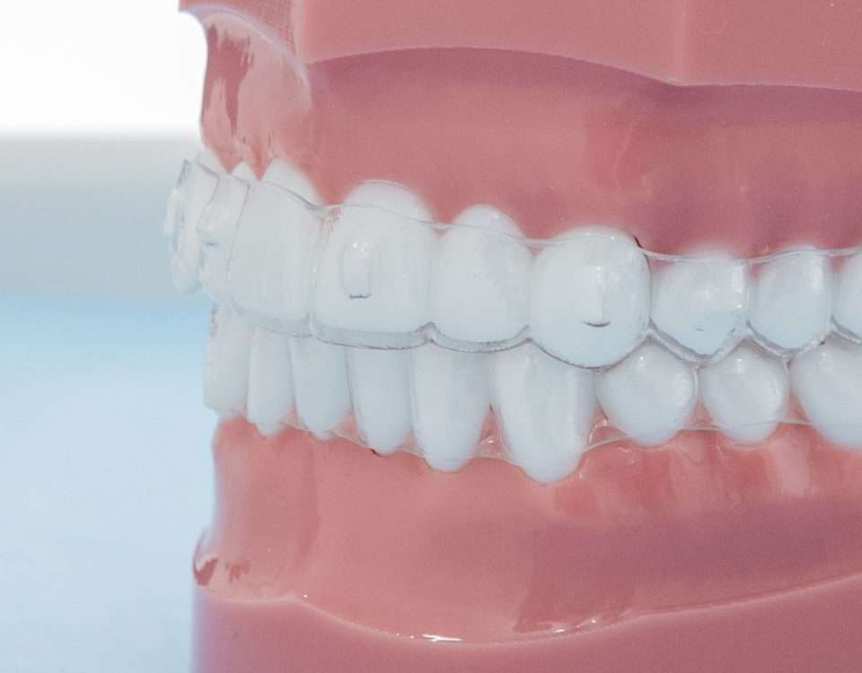 Modelo de maxilar con alineadores transparentes ajustados sobre los dientes para ortodoncia invisible